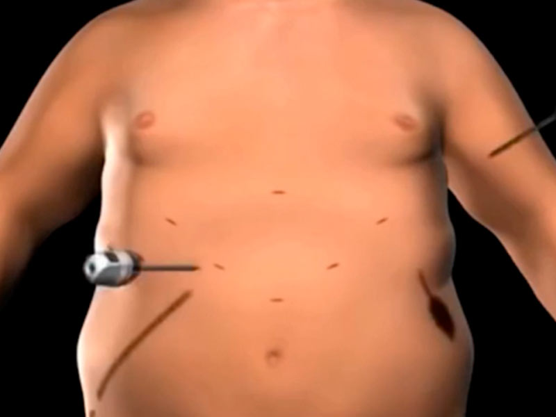 cirurgia bariátrica sleeve