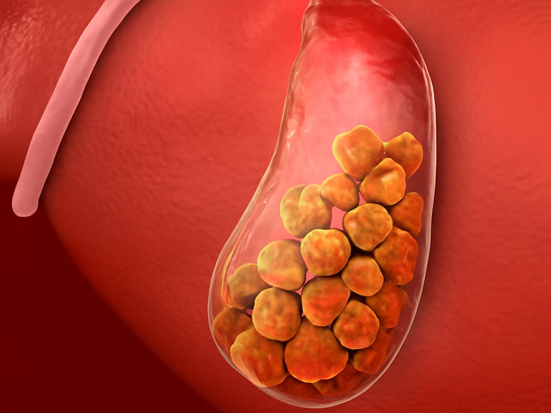 doenças da vesícula biliar