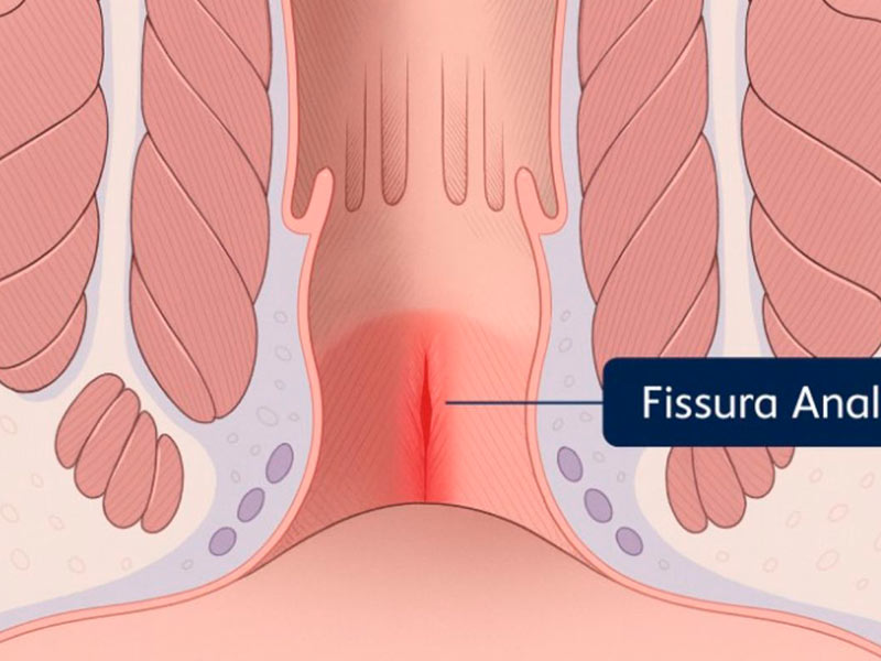 fissura anal